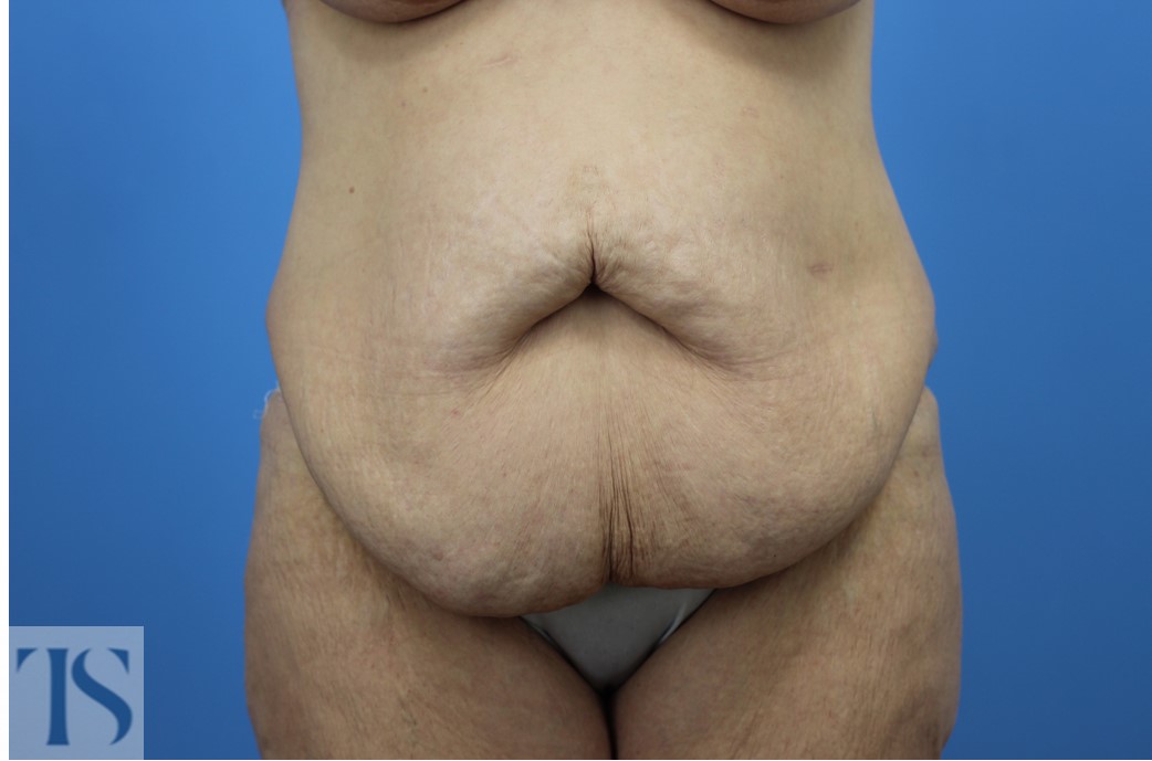 abdominoplasty