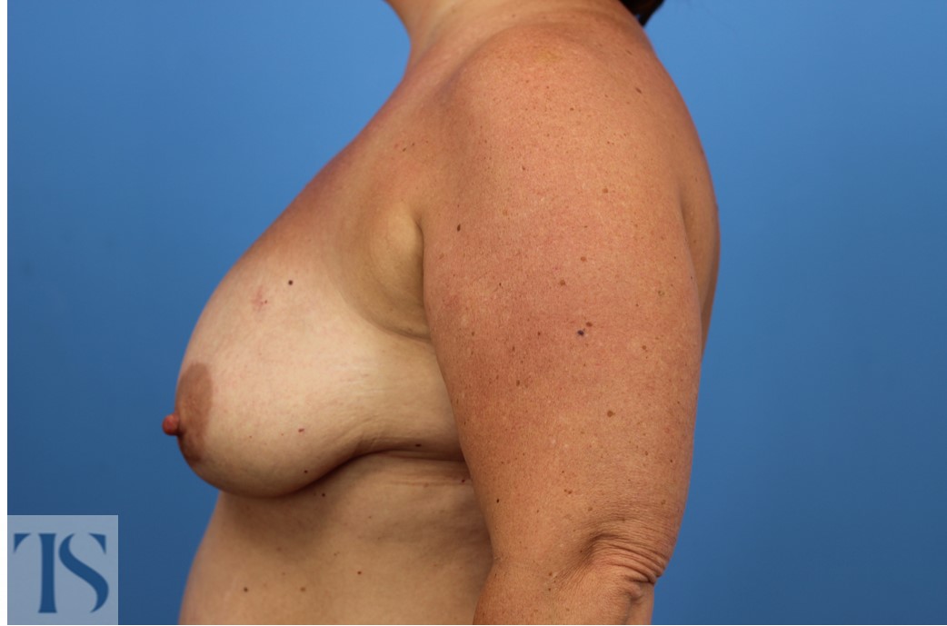 Breast Reconstruction - Abdominal Donor