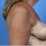 Breast Reconstruction Latissimus