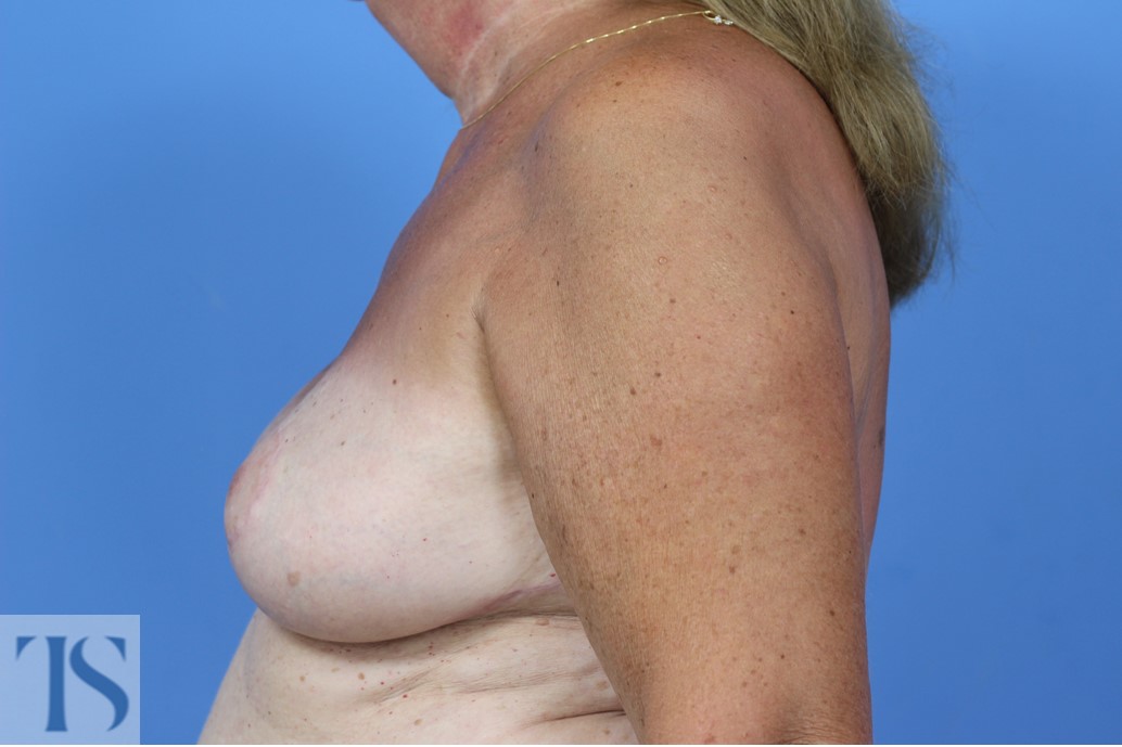 Breast Reconstruction Latissimus