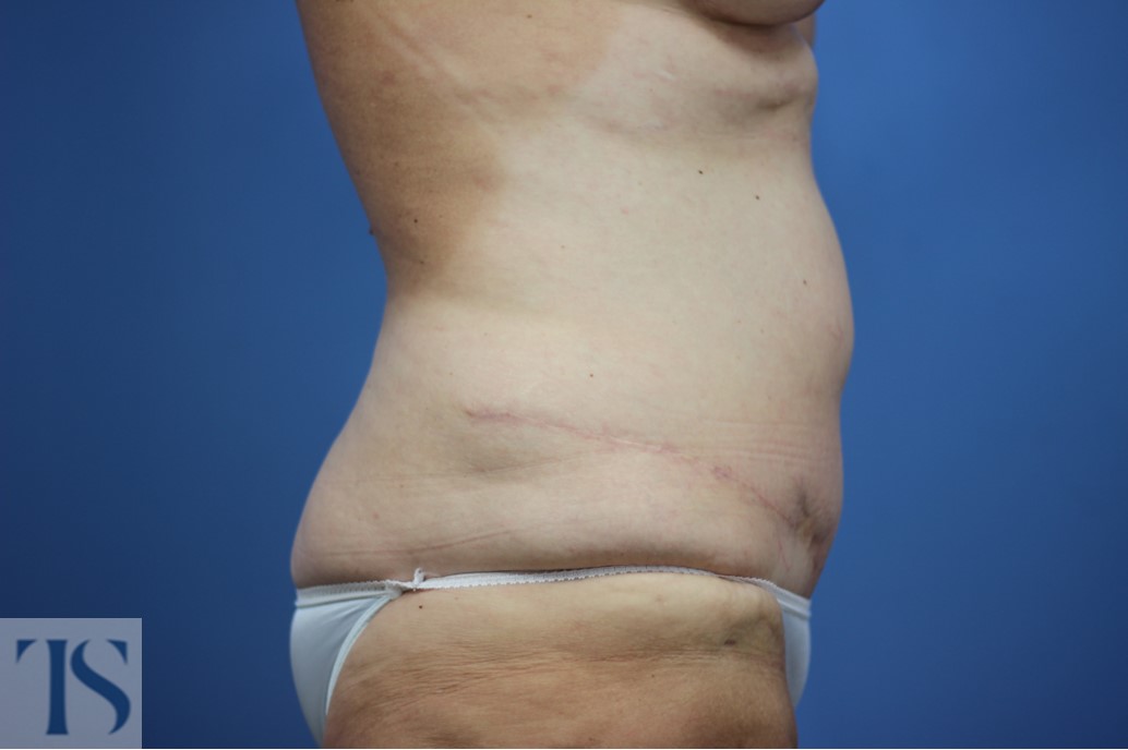 Tummy Tuck Hernia Repair: What You Need To Know - Heights Plastic Surgery