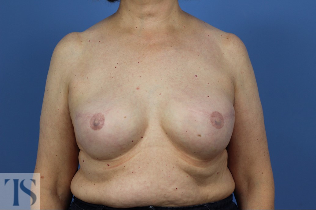 Breast Reconstruction Implant
