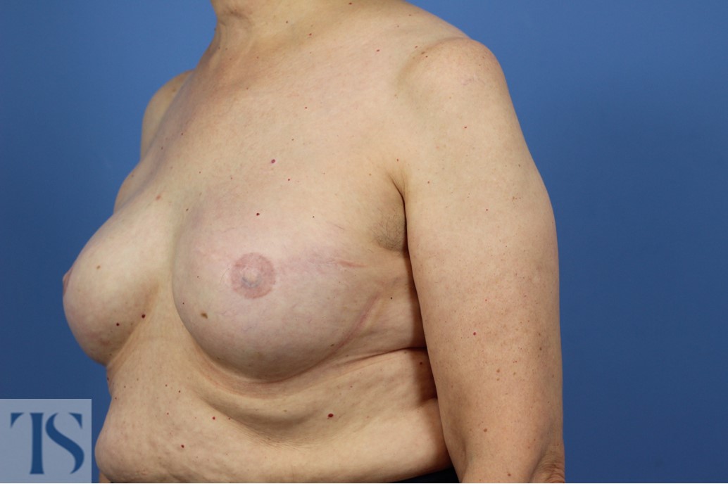 Breast Reconstruction Implant