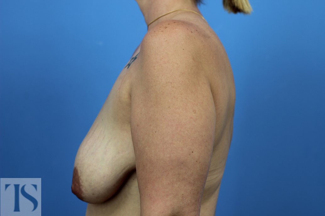 mastopexy breast lift