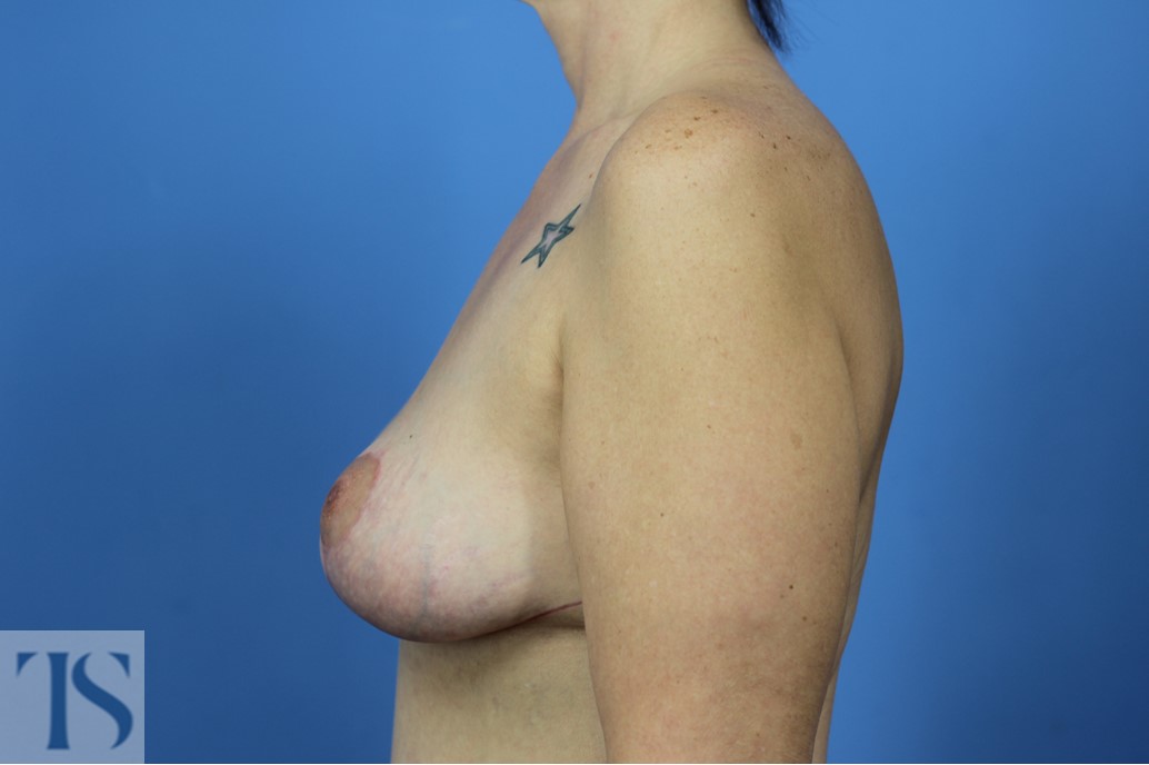 mastopexy breast lift